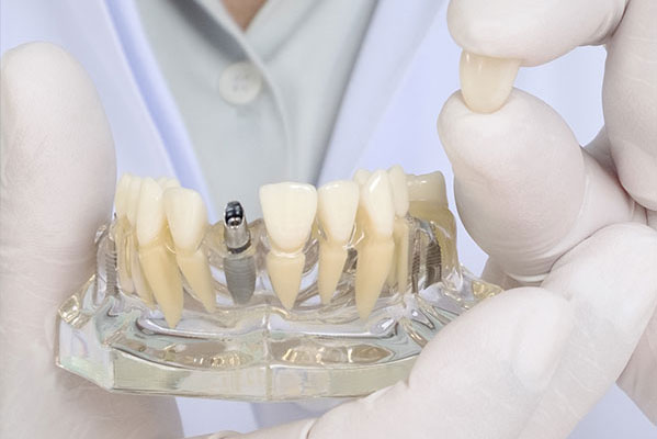 Dental Implants Gardena